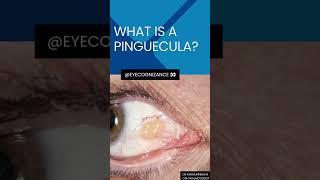 what is a pinguecula ¦eyecognizance [upl. by Nitram]