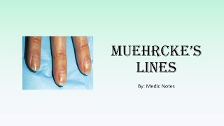 Muehrckes lines causes and pathophysiology [upl. by Jannelle]