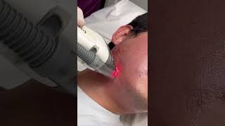 Dr Molinari  Traitement acné 2ème partie  laser Fraxel [upl. by Keese]