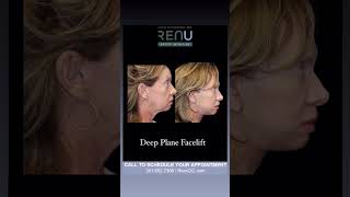 Deep Plane Facelift See this Stunning Transformation [upl. by Aihsekyw]