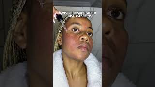 This is how to use the VIRAL Banish Kit for acne scars acne microneedling acnescars [upl. by Ainollopa]