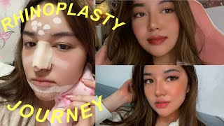 MY RHINOPLASTY JOURNEY 2 WEEKS POSTOP  Andrea Angeles [upl. by Aivato]