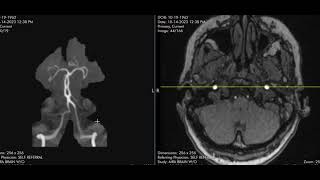 Basilar artery fenestration [upl. by Eilah]