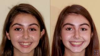 Braces Before and After with Reshaping of Front Teeth [upl. by Devitt901]