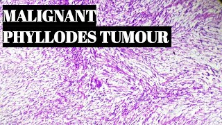 Malignant Phyllodes Tumour Histopathology [upl. by Carey]