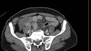 Acute Appendicitis [upl. by Kaspar]