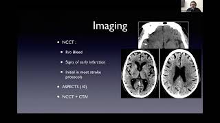 DrDheeraj Khurana  Stroke Thrombolysis quotHow I do itquot [upl. by Lavella]