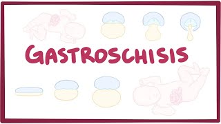 Gastroschisis  causes symptoms diagnosis treatment pathology [upl. by Norrag]