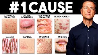 The MOST Common Deficiency in All Skin Diseases Dermatitis [upl. by Zoie]