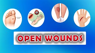 Types of Open Wounds Abrasion Laceration Skin Avulsion Puntured wounds [upl. by Aiceila]