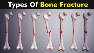 Common types of Bone fracture  3D animation [upl. by Ezaria]