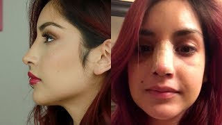 Dealing with Post Surgery Blues After Rhinoplasty 10 Months PostOp [upl. by Compton46]