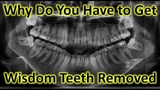 Why Do You Have to Get Wisdom Teeth Removed Do I need my Wisdom Tooth pain [upl. by Vasily]