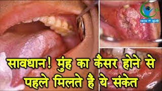 Mouth Cancer होने से पहले शरीर देता है ये संकेत भूलकर भी ना करें नजरअंदाज  Symptoms [upl. by Petite]