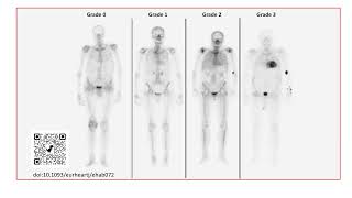 Cardiac amyloidosis multimodality assessment slides only [upl. by Ahsercal]