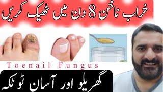 خراب ناخن کا علاج  Nail Fungus Healthmatters22 healthtips Healthmatters22 DrKhurram [upl. by Fink]