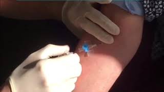 cannulation Technique in ACF [upl. by Weisbart]