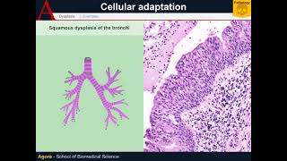 Cellular Pathology  Dysplasia [upl. by Ertsevlis]