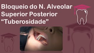 Anestesia da Tuberosidade  Bloqueio do Nervo Alveolar Superior Posterior [upl. by Dorothea]