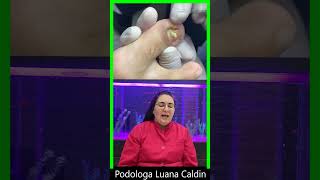 Luana Caldin podologa podologia unhas pedicure manicures encravada encravadas unha [upl. by Byron]