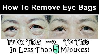 How To Get Rid of amp Remove Eye Bags Instantly Ageless Puffy Eye Bag Removal [upl. by Ydnam]