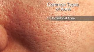 How to Treat Different Types of Acne [upl. by Eiroc]