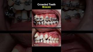 Teeth very crowded and crooked before braces orthodontist braces dentist [upl. by Jacki]