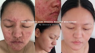 How I cleared acne rosacea without medication  Skincare storytime amp simple routine [upl. by Hendon]