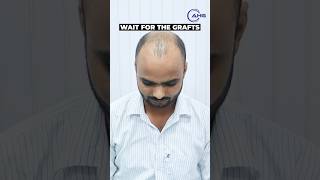 Hair Loss Solution for Men  Hair Transplant in Haridwar  DHI Hair Transplant  Hairline shorts [upl. by Gunning]