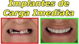 Implantes Dentários com Carga Imediata  O Que São [upl. by Sudbury]