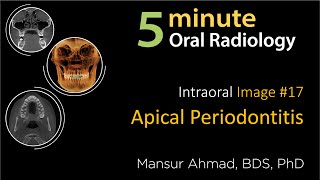 Apical Periodontitis Intraoral Radiographic Interpretation [upl. by Uolymme311]