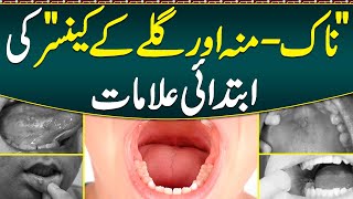 Muh Ke Cancer Ka Ilaj Muh or Galay Ka Cancer Qn Hota Ha  Oral Cancer Causes Symptoms amp Treatment [upl. by Koloski]