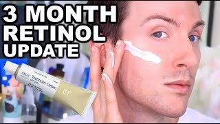 MY FIRST 3 MONTHS ON RETIN A  RETINOL BEFORE AND AFTER [upl. by Idoj488]