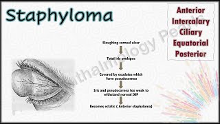 Staphyloma  Undergraduate Examination revision pearls 15 [upl. by Elleynad]