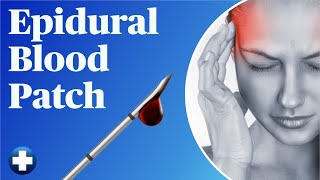 Spinal Headache Epidural Blood Patch StepByStep [upl. by Anneg]