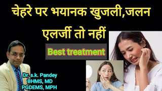 चेहरे पर खुजलीजलन एलर्जी तो नहीं सबसे अच्छी होमियोपैथिक दवा Dr sk Pandey BHMS MD [upl. by Atwater]