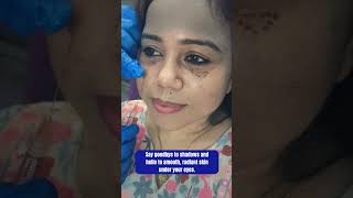 UnderEye Filler Treatment  Skin Clinic  Skin Treatment  Kolkata  youtubereels youtubeshorts [upl. by Eide21]