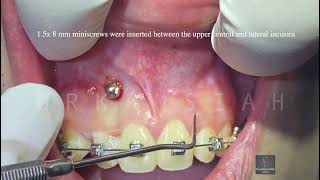 The application of TADs for Gummy Smile Correction  How to [upl. by Nwadrebma294]