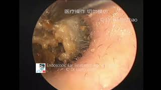 Endoscopic ear treatments by Dr Zhao EP 21  20042020 [upl. by Lenz820]