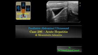 Ultrasound Case 286  Acute Hepatitis and Mesenteric Adenitis [upl. by Calvano584]