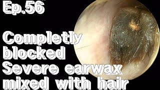 ep56 Severe earwax removal [upl. by Aerdma]