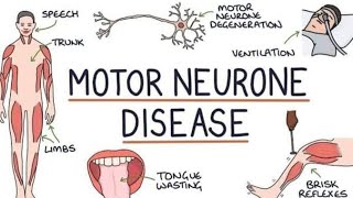 Motor Neuron Diseases Signs amp Symptoms  MND Homeopathic Treatment motorneuronedisease mnd [upl. by Drislane]