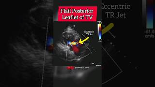 Flail Tricuspid Valve Posterior Leaflet of Heart ♥ echocardiography heart [upl. by Aivata]