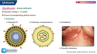 Urticaria Classification Pathogenesis Clinical Features Treatment [upl. by Ruhnke]