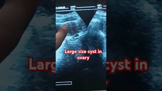 Largest cyst in ovaryshortyoutubevideo pregancyultrasound pregnant [upl. by Amesari]