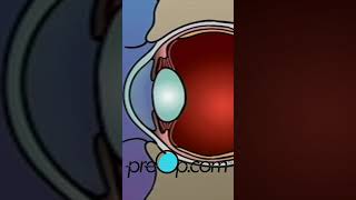 PreOp® 👁️ What to Expect with LASIK Laser Eye Surgery preop shorts health 🌟 [upl. by Itsirk82]