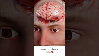 Brain Aneurysm Clipping Surgery ↪ 3D Medical Animation Shorts Brain AneurysmClippin [upl. by Laekim]