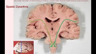 Spastic dysarthria  samples and tutorial [upl. by Nanni21]