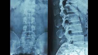 lumbar spine xray intervertebral discs on Xray revisited [upl. by Greysun]