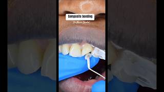 Composite Bonding on front tooth viral composite compositebondingcosmeticssmileteethdentist [upl. by Mckale]